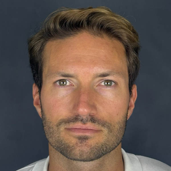 After: Men's hair restoration - Patient 2