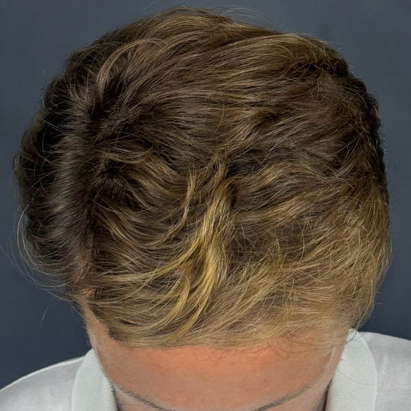 After: Men's hair restoration - Patient 3