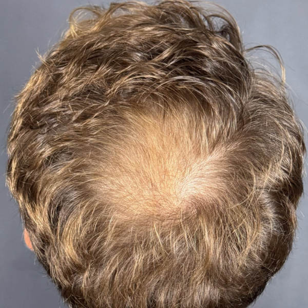Before: Men's hair restoration - Patient 1