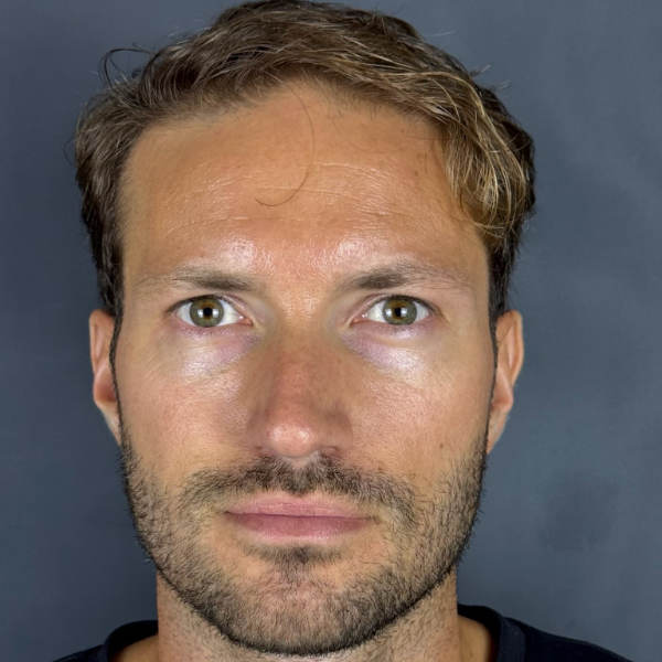 Before: Men's hair restoration - Patient 2