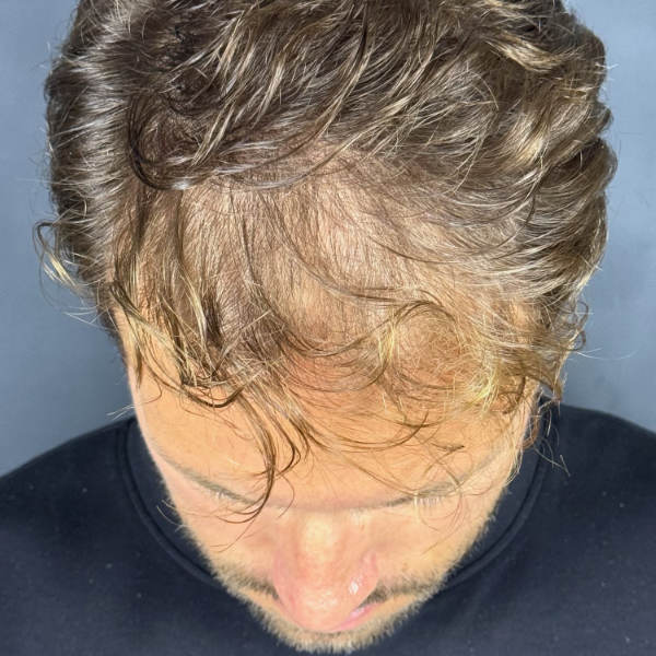 Before: Men's hair restoration - Patient 3