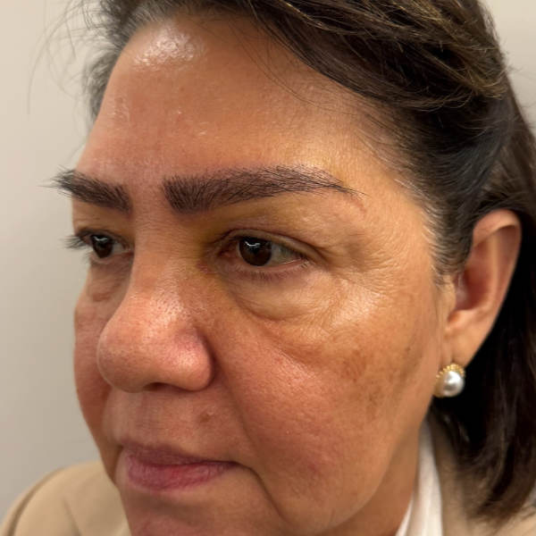 After: Eyebrow restoration - Patient 1
