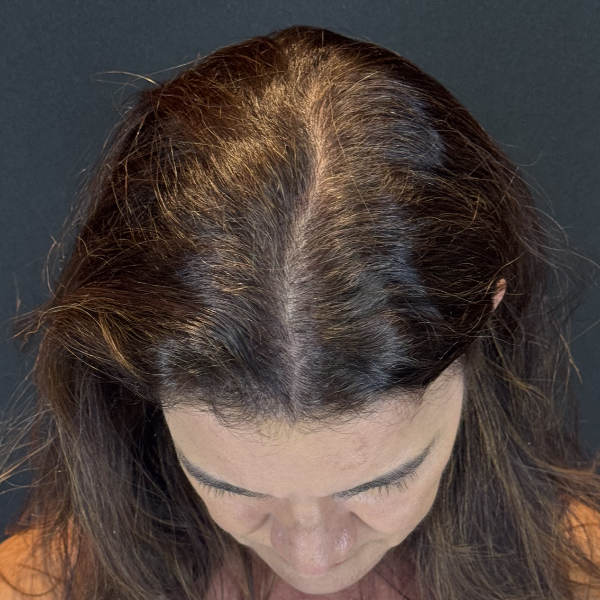 Before: Women's hair restoration - Patient 1